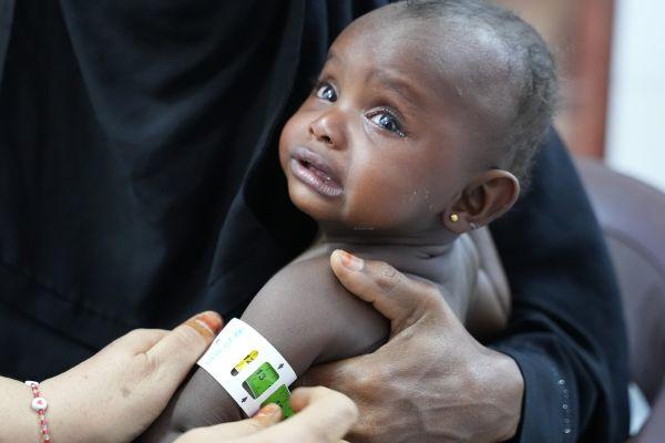 Reem Mare’i, de 20 meses, asiste a control por malnutricion. 